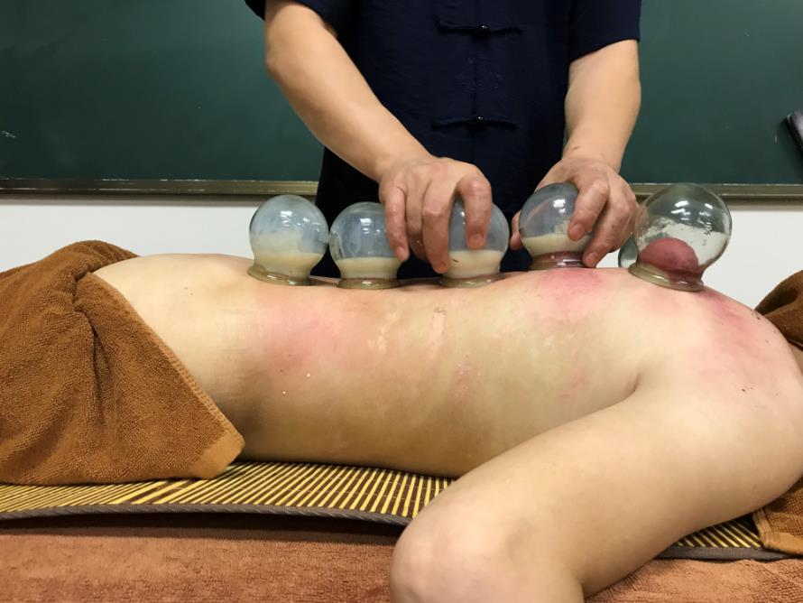 中醫可以通過拔罐辨別體質