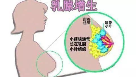 刮痧能治療乳腺小葉增生嗎？