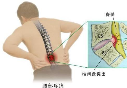 腰椎間盤突出怎么辦？不妨試試中醫針灸