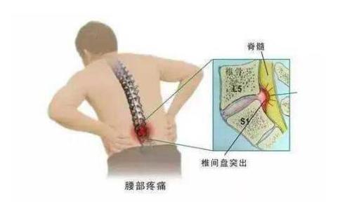 哪些人容易患腰間盤突出？中醫是如何治療的？